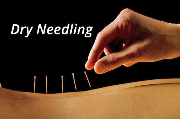 image-717728-dry-needling2.jpg